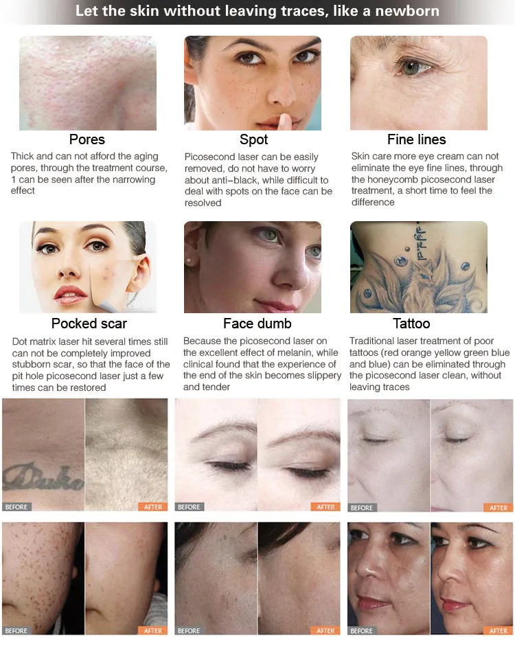 New Arrival! Laser Picosecond/ Laser Picosur 1064 532 Tattoo Machine/Pigmenation Removal