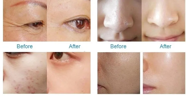 New Design Skin Rejuveration Vanadium-Titanium Meso Injector Mesotherapy Gun