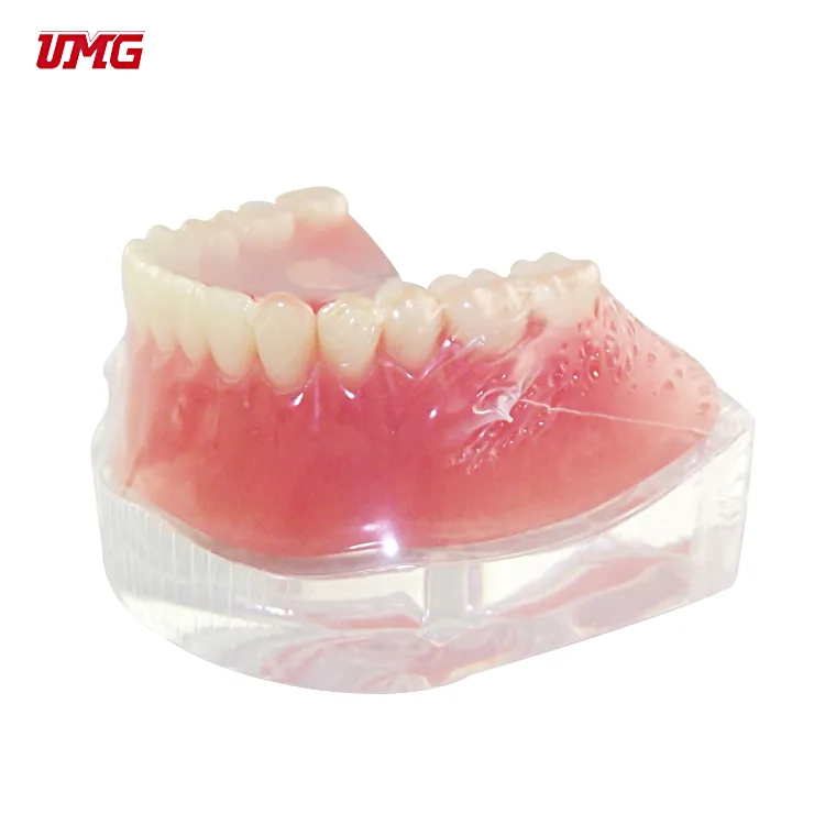 New Promotion Communication Teeth Model Implant with Clip Attachments