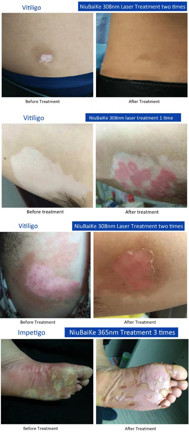 Niubaike Best Vitiligo Patches Treatment in World Vitiligo in Men