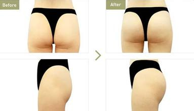 Otesaly 10ml Derm Plus Breast Buttock Ha Injectable Filler Hyaluronic Acid Dermal Filler