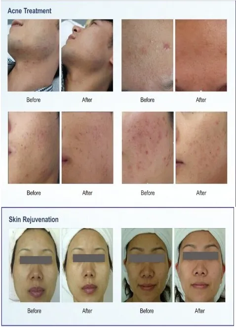 PDT/LED Beauty Equipment Skin Fresh Therapy Anti-Ageing Treatment