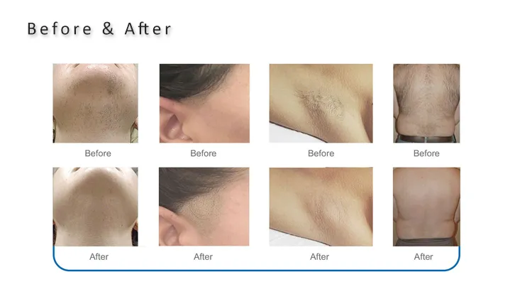 Permanent 808 Diode Duet Laser Diode Laser Hair Removal 808nm CE Approved