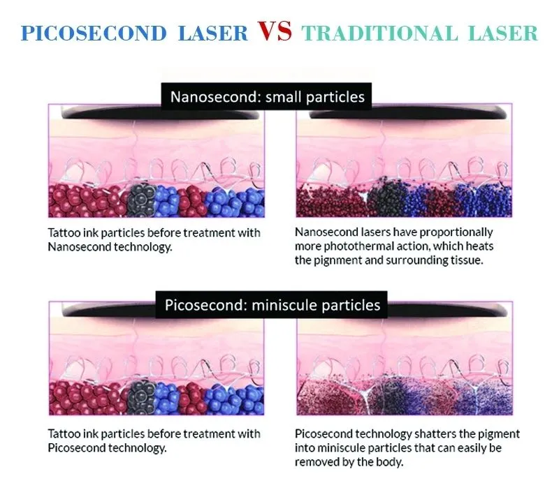 Pico Second Picosecond Laser Tattoo Removal Freckle Removal Machine for Sale