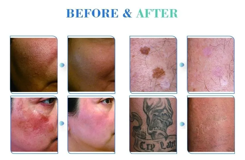 Pico Second Picosecond Laser Tattoo Removal Freckle Removal Machine for Sale