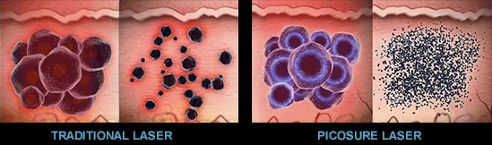 Picosecond Laser Remove Freckle, Age Pigment Remove Nevus of Ota/Congenital-Birthmark