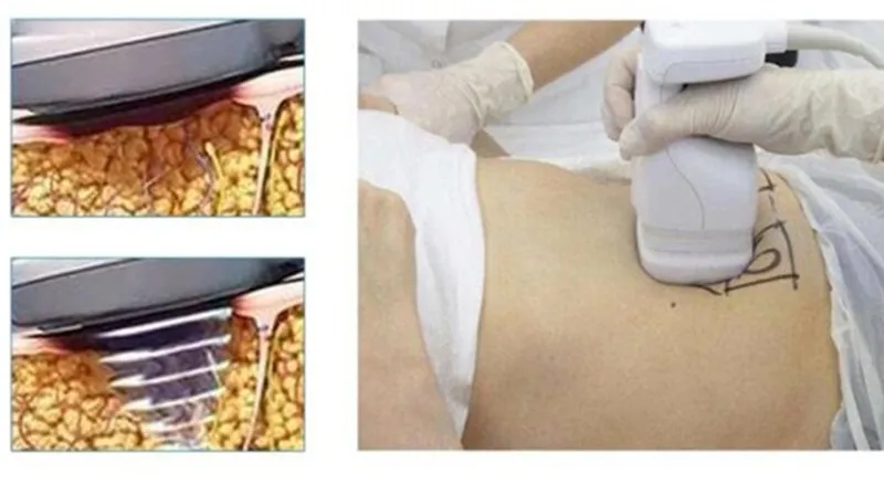 Portable Cellulite Reduction Body Slimming Machine for Weight Loss