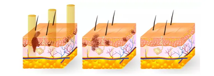 Portable Chloasma Q Switched ND YAG Laser Picosecond Laser Tattoo Removal Picosecond Laser Tattoo Removal Machine with CE