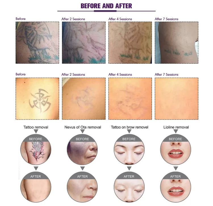 Portable Chloasma Q Switched ND YAG Laser Picosecond Laser Tattoo Removal Picosecond Laser Tattoo Removal Machine with CE