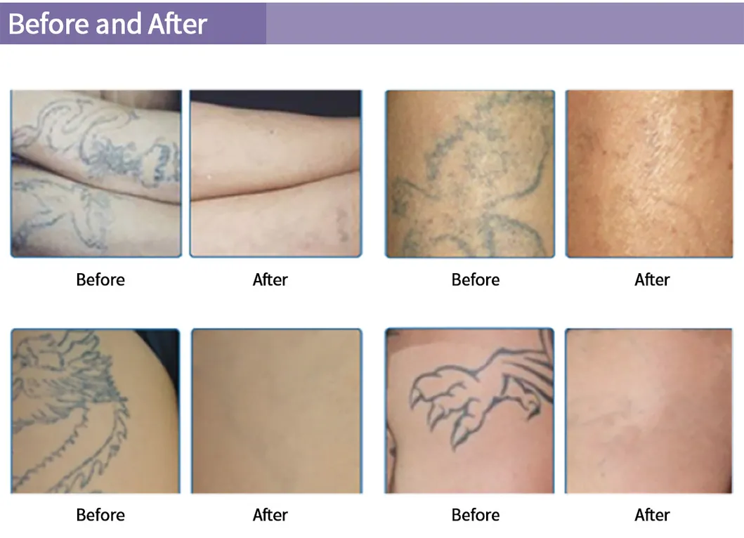 Portable Tattoo Removal Pigmentation Removal Q Switched ND YAG Laser 532nm 1064nm 1320nm Carbon Peeling Machine