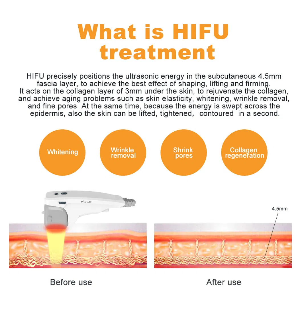 Portable Ultrasound Gel Hifu High Intensity Focused Ultrasound 3D Hifu Maquina