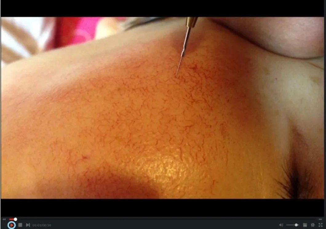 Portable Varicose Veins Spider Vein Removal Diode Laser Machine for Vascular Lesion