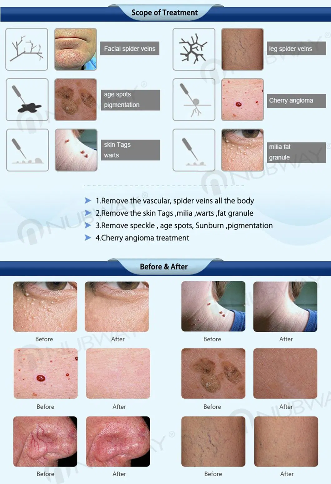 Portable Varicose Veins Spider Vein Removal Diode Laser Machine for Vascular Lesion