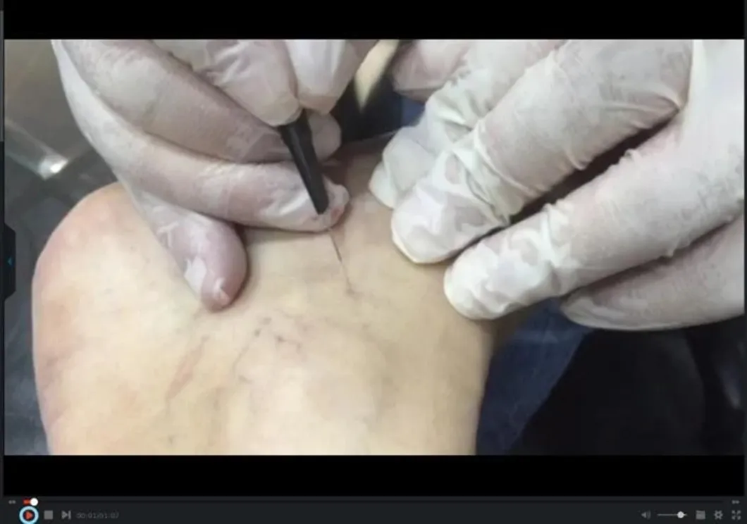 Portable Varicose Veins Spider Vein Removal Diode Laser Machine for Vascular Lesion