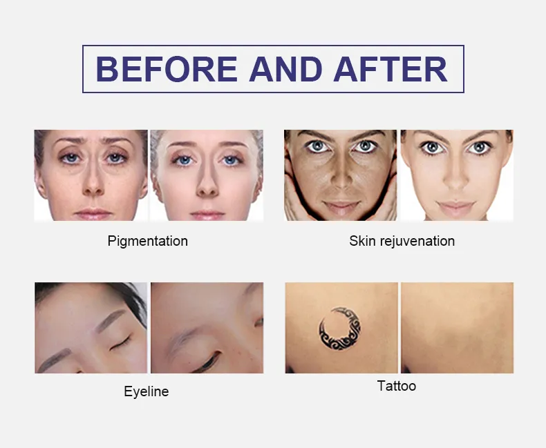 Powerful Skin Freckles Removal Black Pigment Removal Equipment Q Switch ND YAG Laser Beauty Device