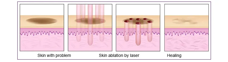2021 Vertical Clinic Scar Removal CO2 RF Laser Machine Fractional CO2 Laser Vaginal Skin Rejuvenation