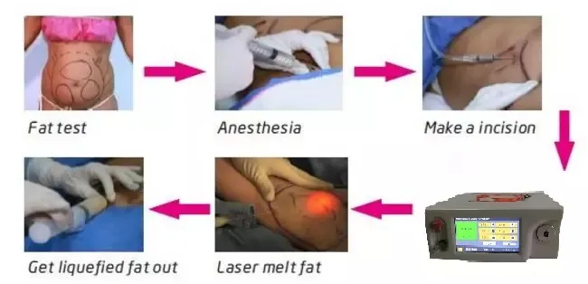 Professional Medical Apparatus Good Feedback Removal Blood Vessels 4 In1 Vascular Laser 980nm Diode Laser