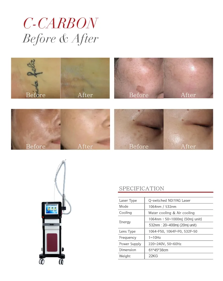 Professional Portable ND YAG Laser for Tattoo Removal System