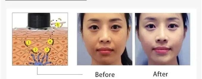 Professional Ret Cet Monopolar Radio Frequency Slimming Apparatus for Body Contouring