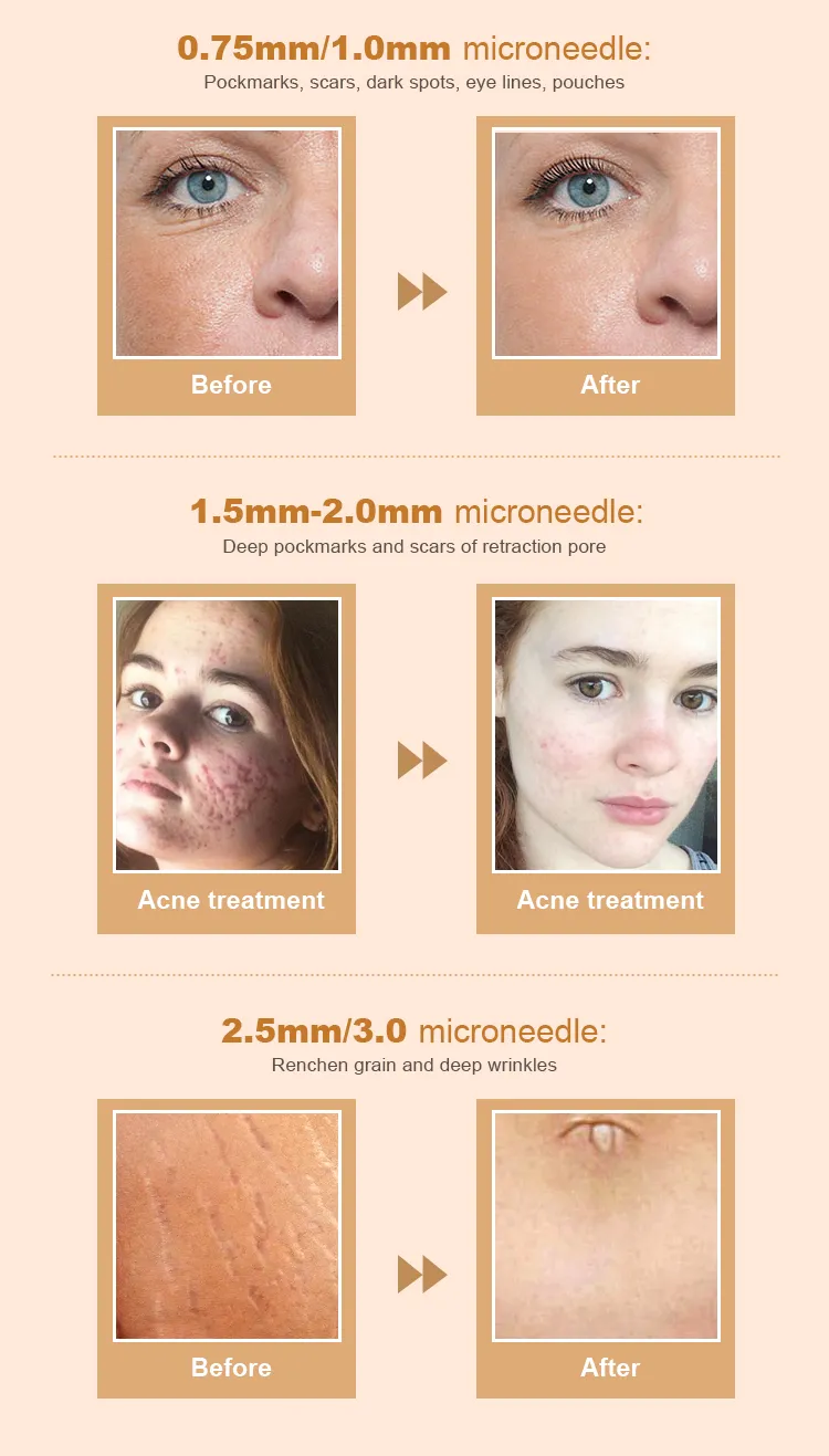 Replacement Head Derma Tool Mts Skin Care Roller 1mm with Gold Micro-Needle Therapy System Mts