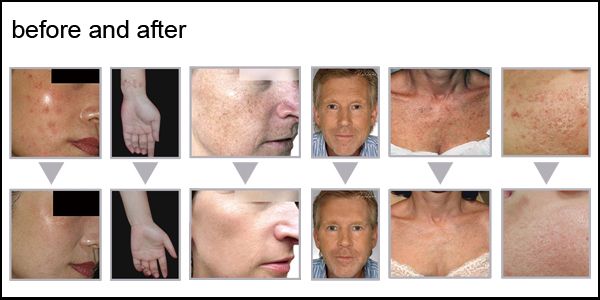 RF CO2 Fractional Laser Skin Renewal Cosmetology Machine