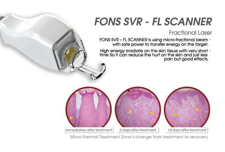 Ruikd Professional Fractional CO2 Laser Medical Device for Vaginal Tightening Acne Scar Removal