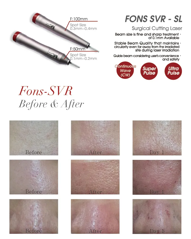 Ruikd Professional Fractional CO2 Laser Medical Device for Vaginal Tightening Acne Scar Removal
