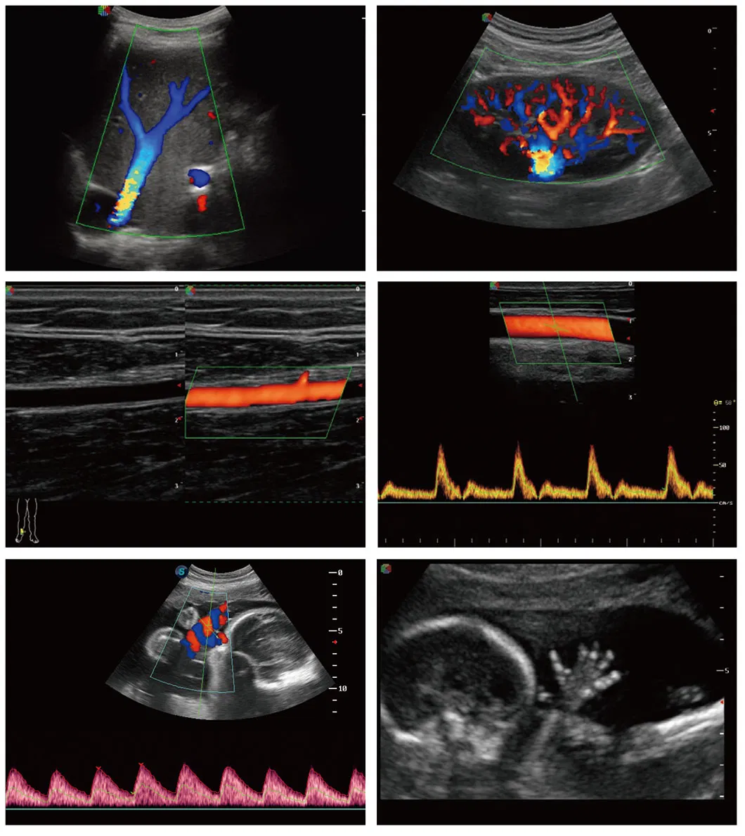 Sonoscape S22 Mobile 3D/4D Color Doppler Ultrasound Scanner