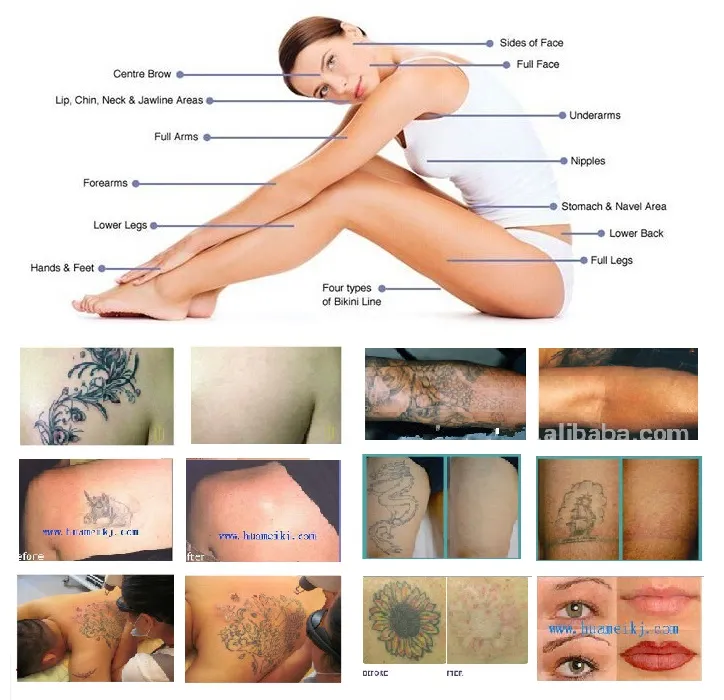 Tattoo Removal