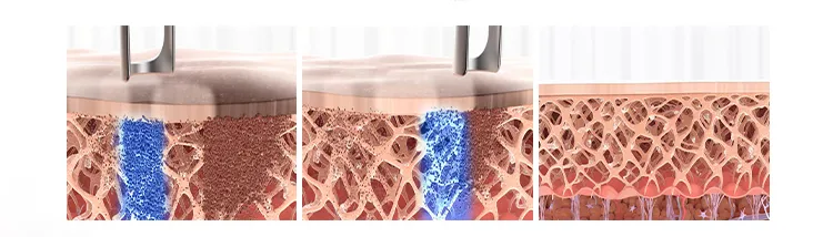 Tattoo Removal YAG High Power Laser Q Switched 1064 ND YAG 532 Skin Care Medical Equipment