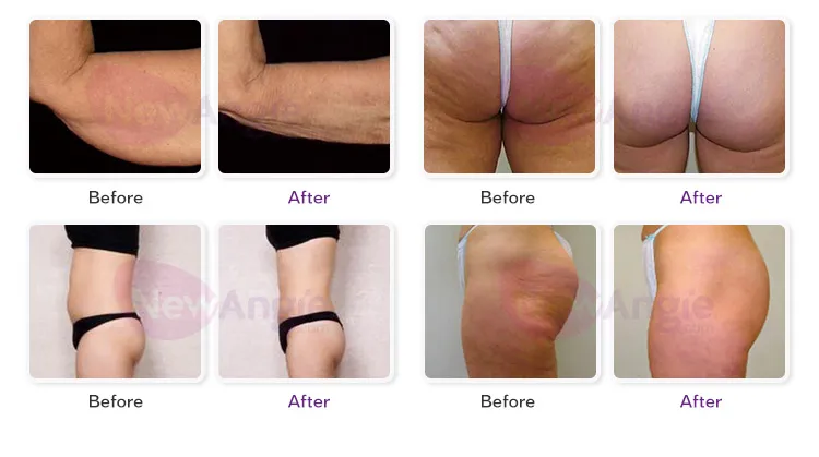 V10 Velashap +V9 Velashap 3 +Cavitation + RF+Vacuum Roller+Bio +Laser Slimming Machine
