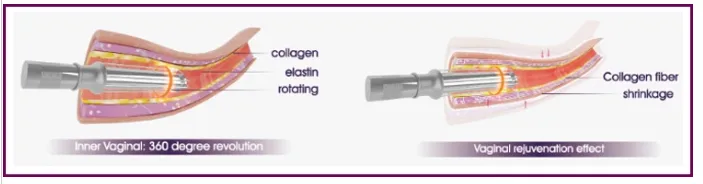 Virginal Tightening Fractional CO2 Laser