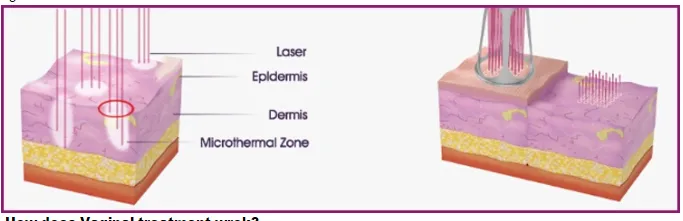 Virginal Tightening Fractional CO2 Laser