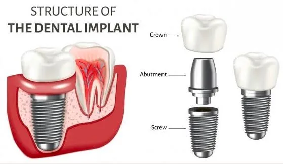 Wego CE SLA Microdual Tread Dental Implant Tooth Implant